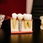 Implanty zębów a kwestie logopedyczne